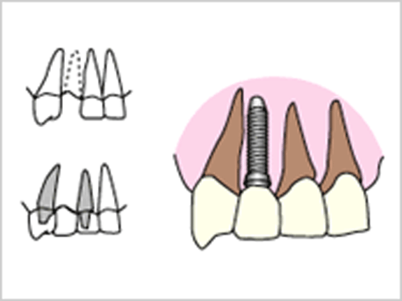 前歯を一本失った場合