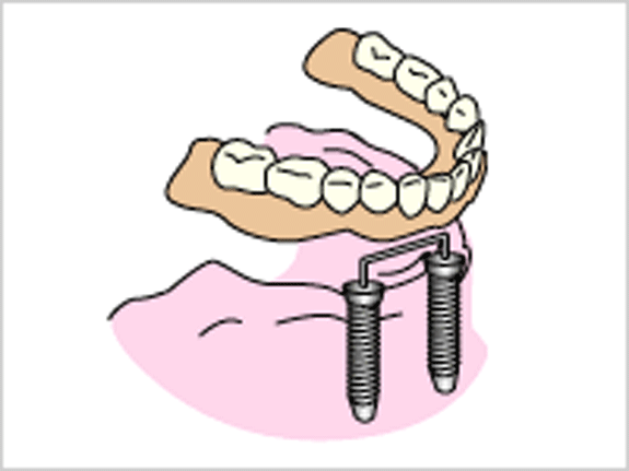 総入れ歯が安定しない場合