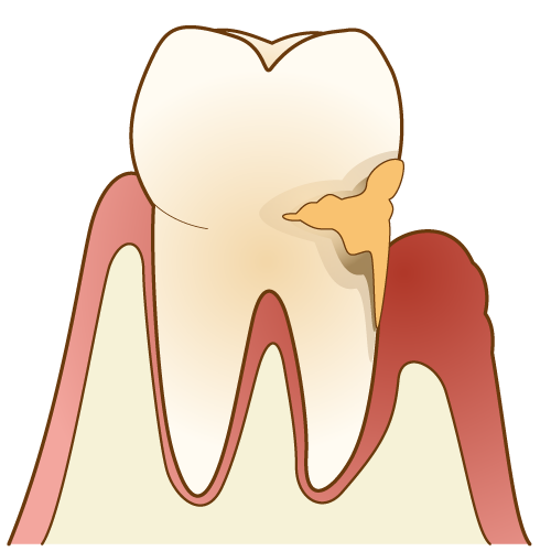 歯周病とは？
