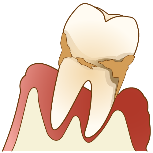 歯周病とは？