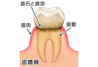 歯肉炎
