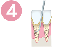 歯周病の治療