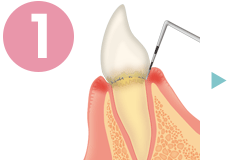 歯周病の治療