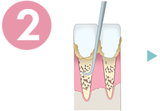 歯周病の治療