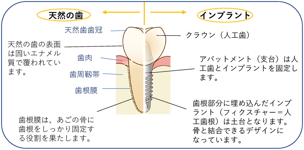 天然歯とインプラントの違い